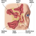 Nasal Polypectomy Laser Treatment